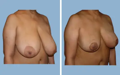 Before and After
